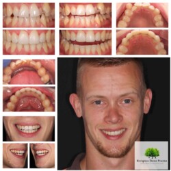 braces 9
