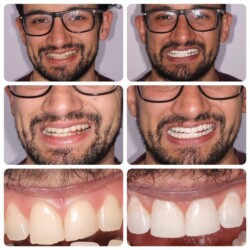 brace image 6