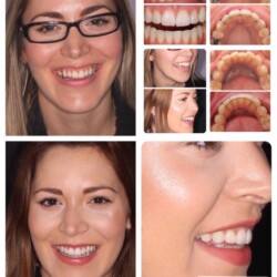 braces 11