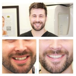braces 7