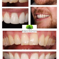 brace image 8