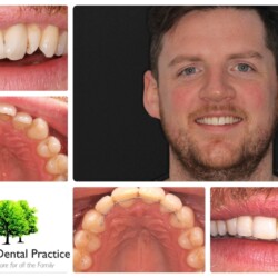 braces 3
