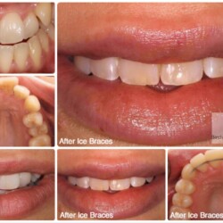 braces 2