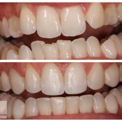 brace image 4