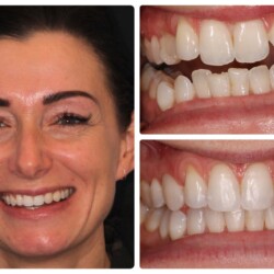teeth straightening cardiff