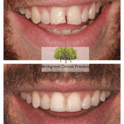 brace image 8