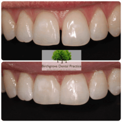 brace image 11