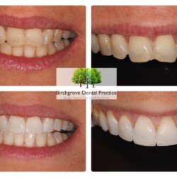 brace and bonding