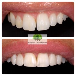 cosmetic bonding case 2