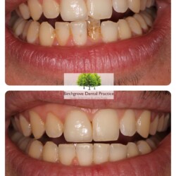 brace case 1