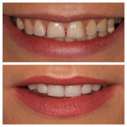 cosmetic bonding case