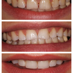 cosmetic bonding before and after