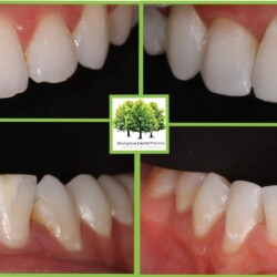 dental bonding cardiff