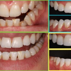 teeth bonding
