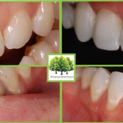 composite bonding image