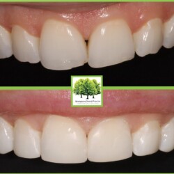 cosmetic bonding in cardiff