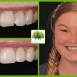 cosmetic bonding
