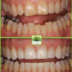 orthodontic results