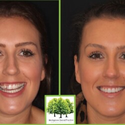 before and after braces