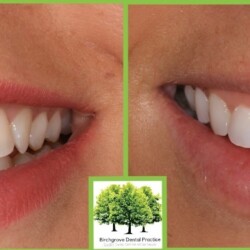 before and after orthodontics