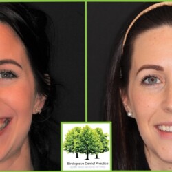 orthodontics before and after