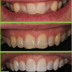 ice braces