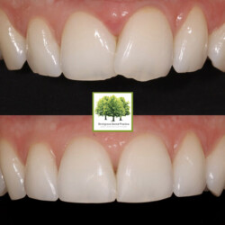 smile makeover cardiff