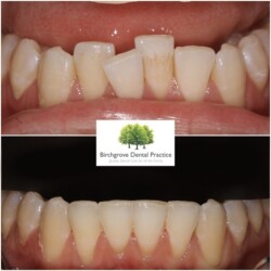 ceramic braces cardiff